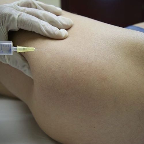 mesoteràpia Sabadell